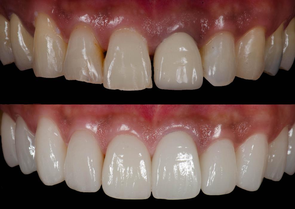 before and after smile makeover in knoxville