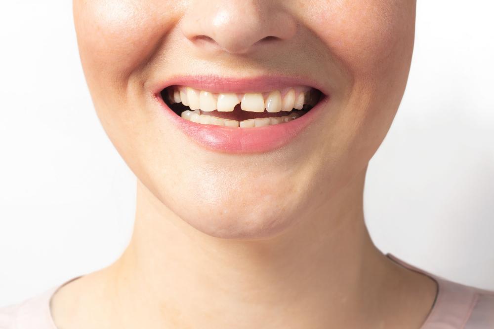 chipped tooth in knoxville