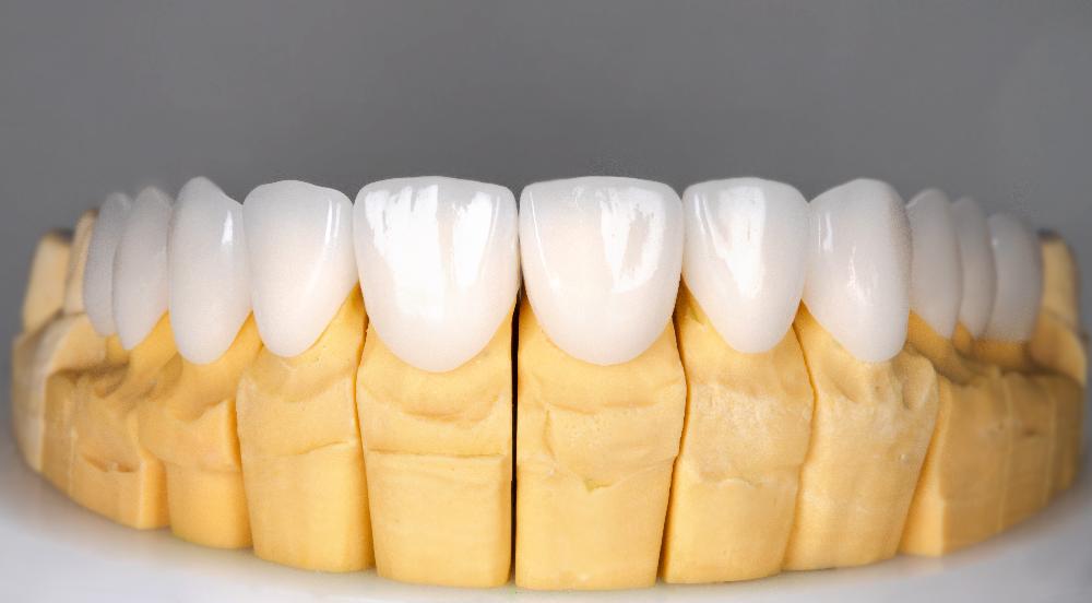 image of veneers in knoxville
