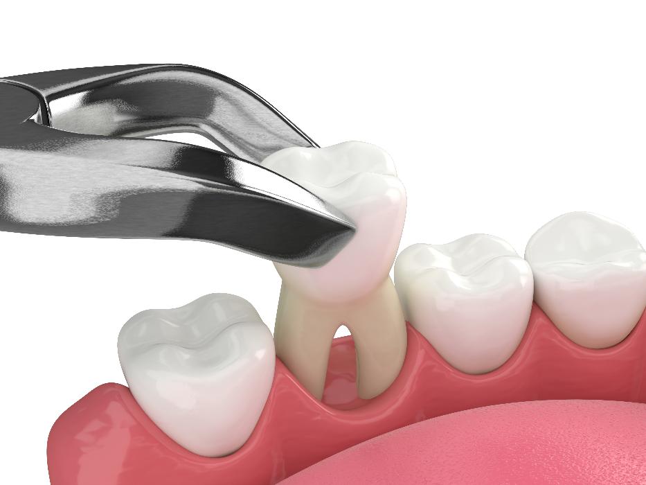tooth extraction knoxville
