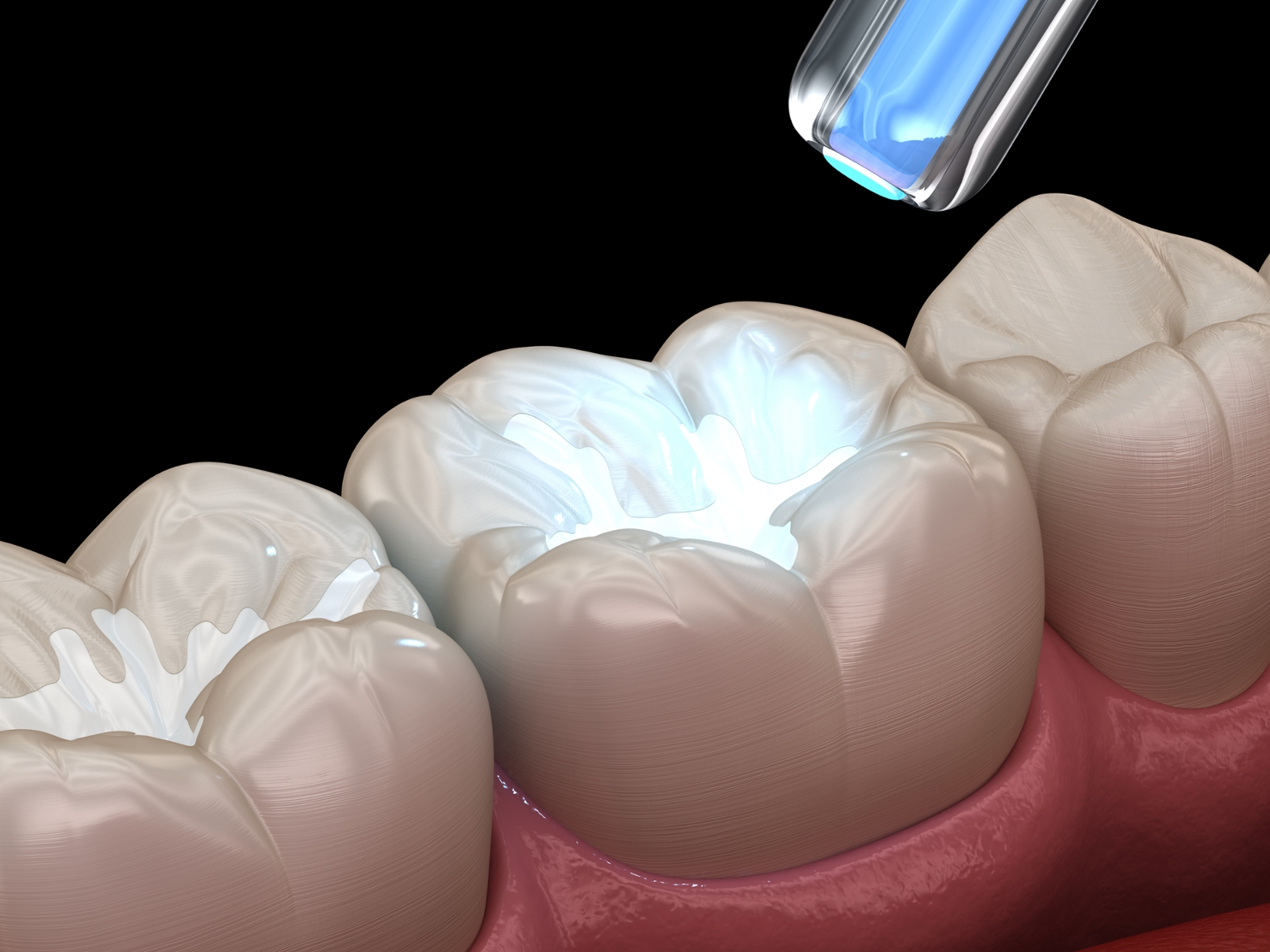close up tooth colored filling on tooth at bryant family dentistry