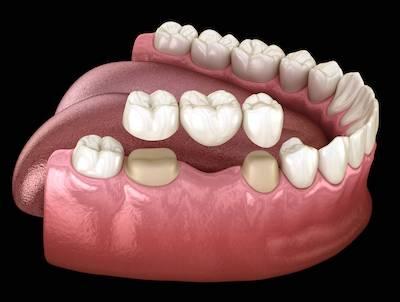 image of a dental bridge in knoxville