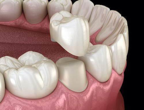 image of a dental crown in knoxville