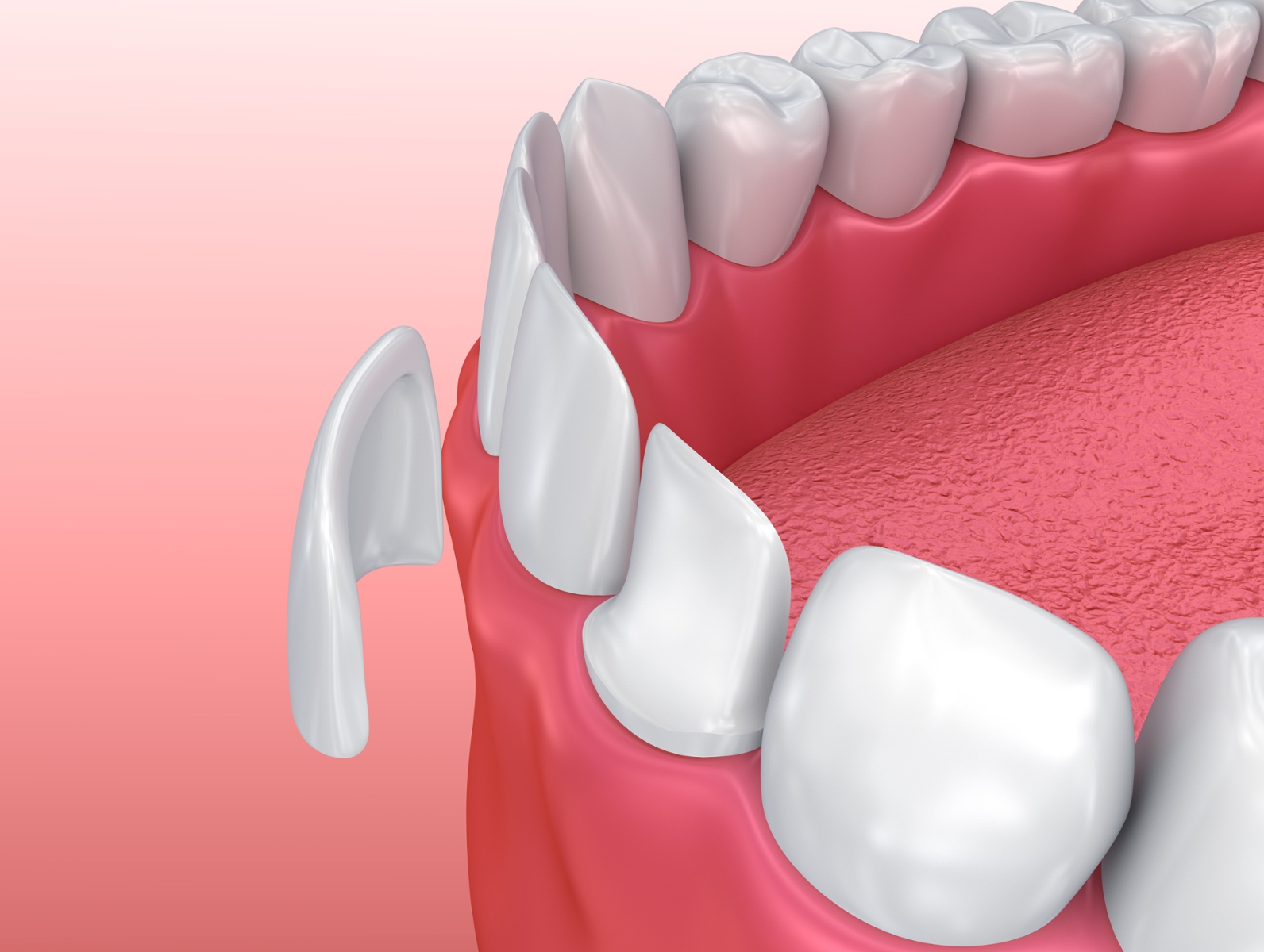 close up of single white porcelain veneer on tooth