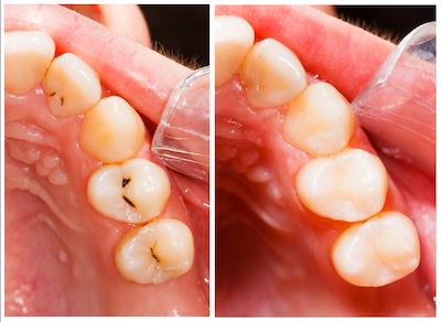 patient getting a composite filling in knoxville