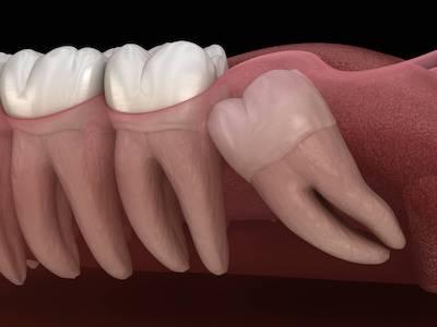 wisdom teeth removal knoxville tn