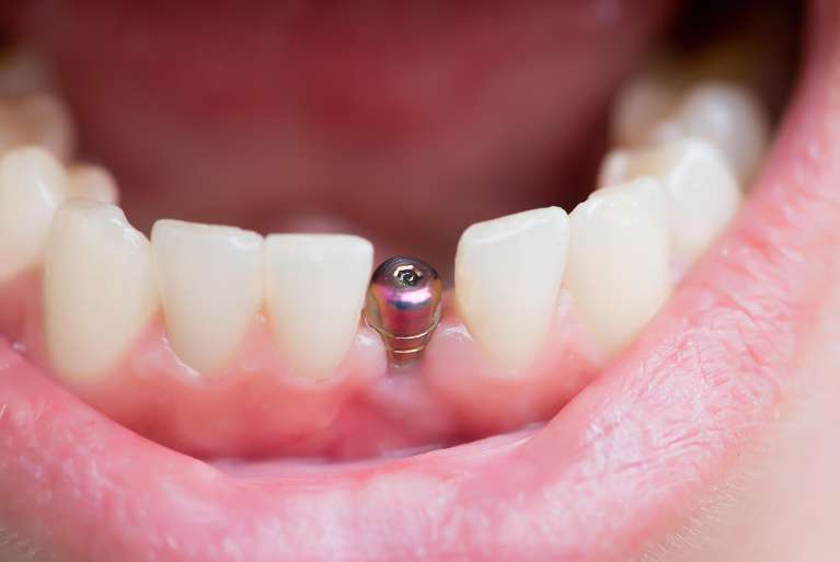 dental implant in knoxville