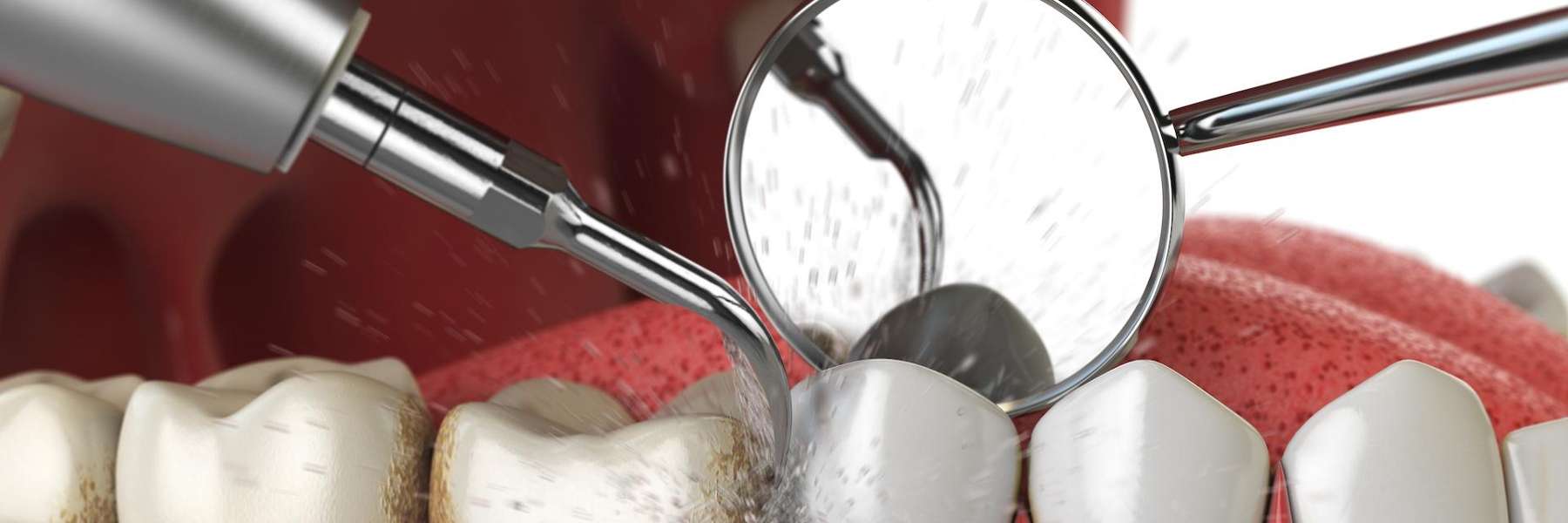 image of a teeth cleaning in knoxville