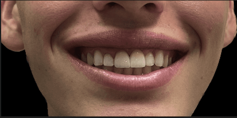 after dental crown knoxville tn