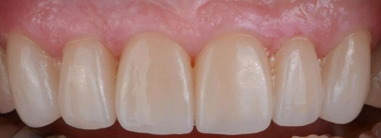 after crowns in knoxville