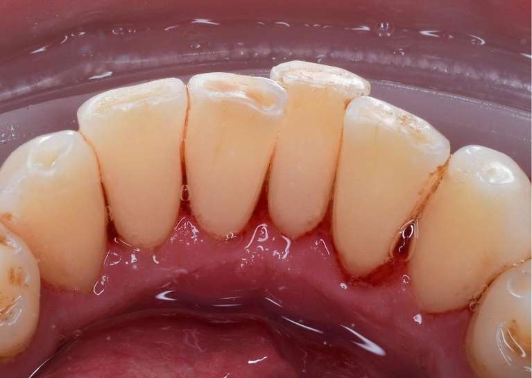 Dental-Cleaning-After-Image