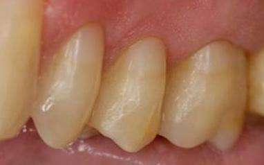 Facial-Fillings-After-Image