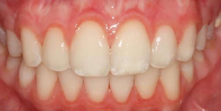 K-R-Whitening-After-Image
