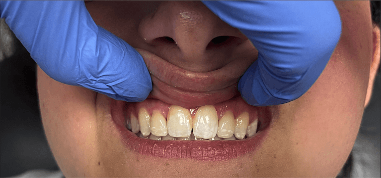 Peg-Laterals-After-Image