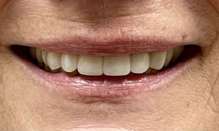 Dental patient in Knoxville with her final dental bridge put in