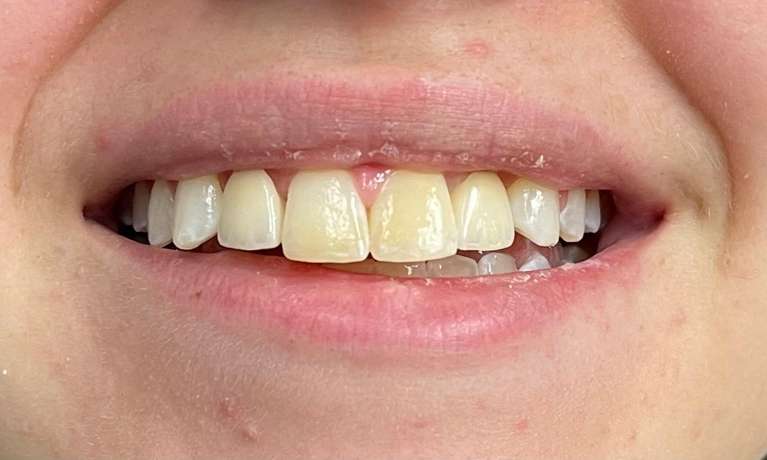 Replacing-Missing-Teeth-Implants-After-Image