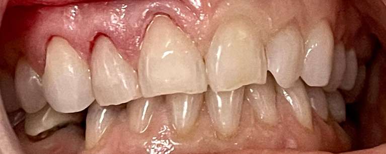 after dental fillings knoxville tn