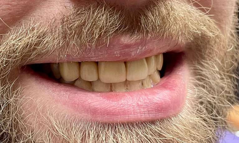 Patient smile after getting crowns in Knoxville