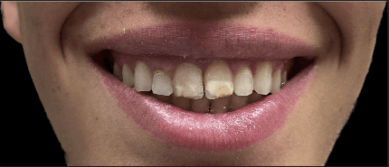 before dental crown in knoxville tn