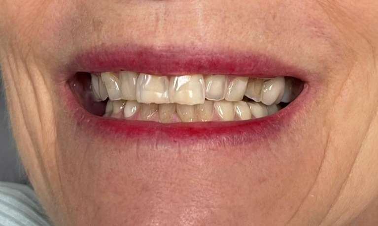 Crowns-Before-Image