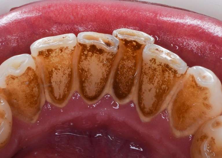 Dental-Cleaning-Before-Image