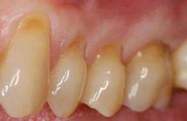 Facial-Fillings-Before-Image