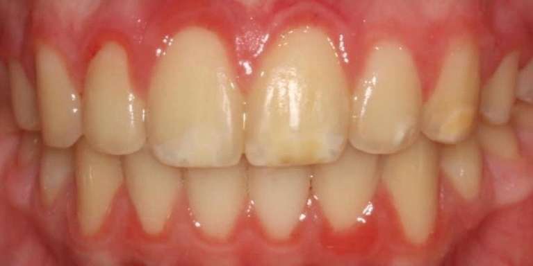 K-R-Whitening-Before-Image
