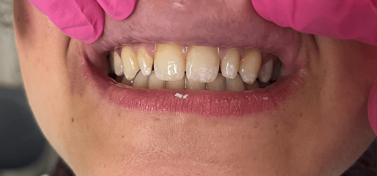 Peg-Laterals-Before-Image