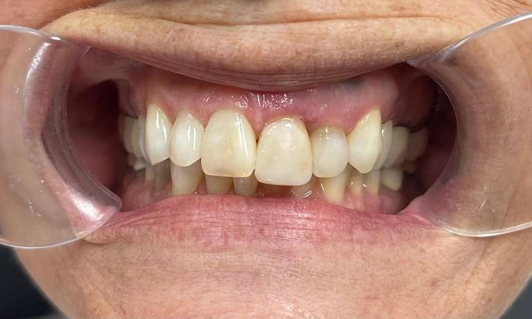 Patient with temporary bridge after losing her two front teeth