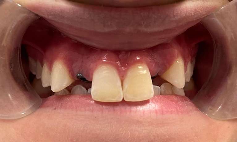 Replacing-Missing-Teeth-Implants-Before-Image