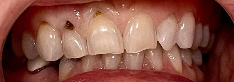 before dental filling knoxville tn