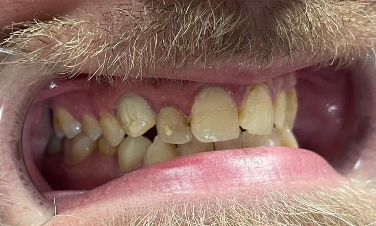 Patient smile before getting crowns in Knoxville